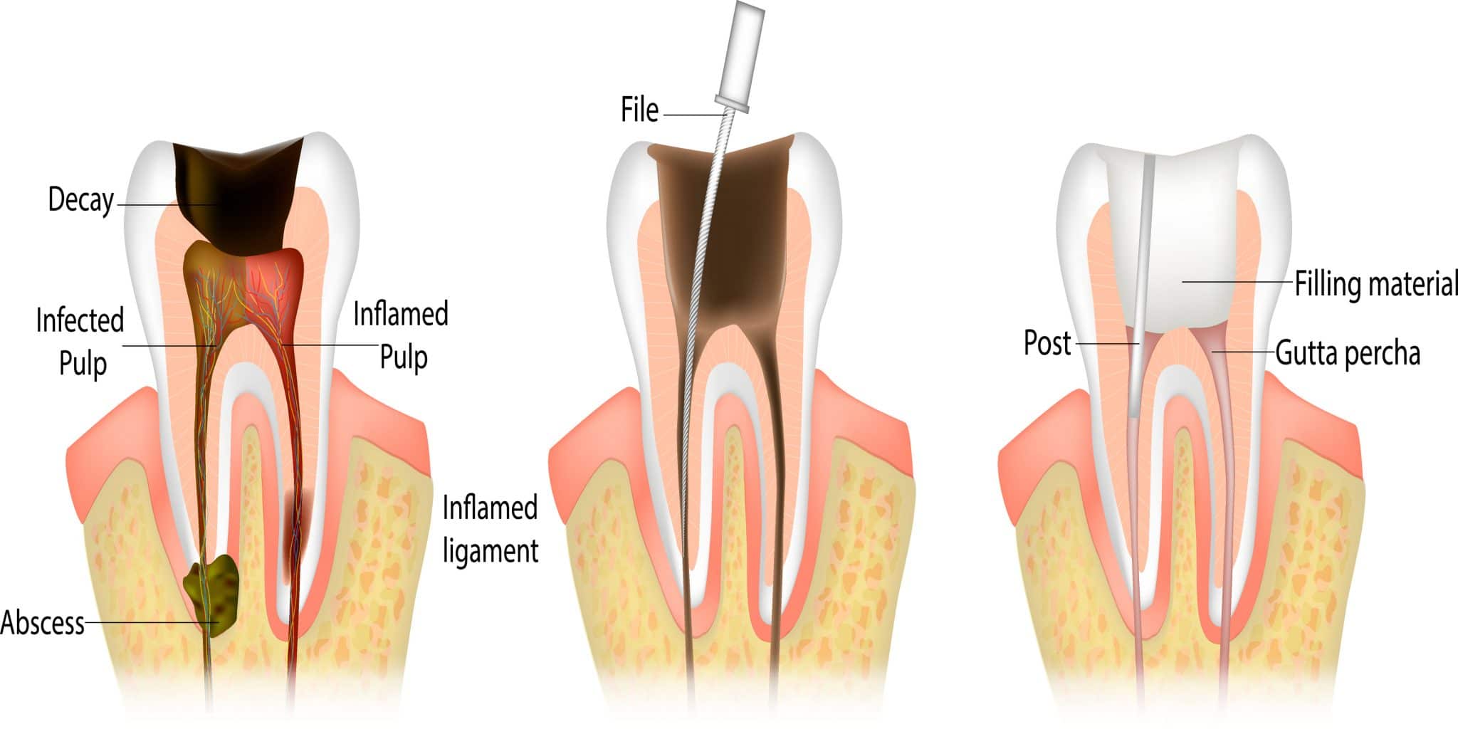 What is a Root Canal?