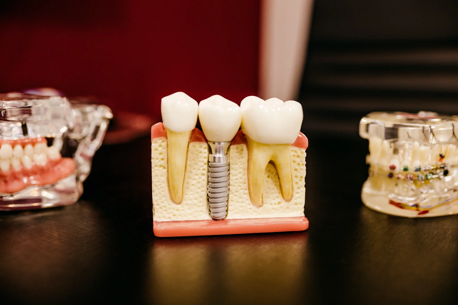 dental Implants and denture 