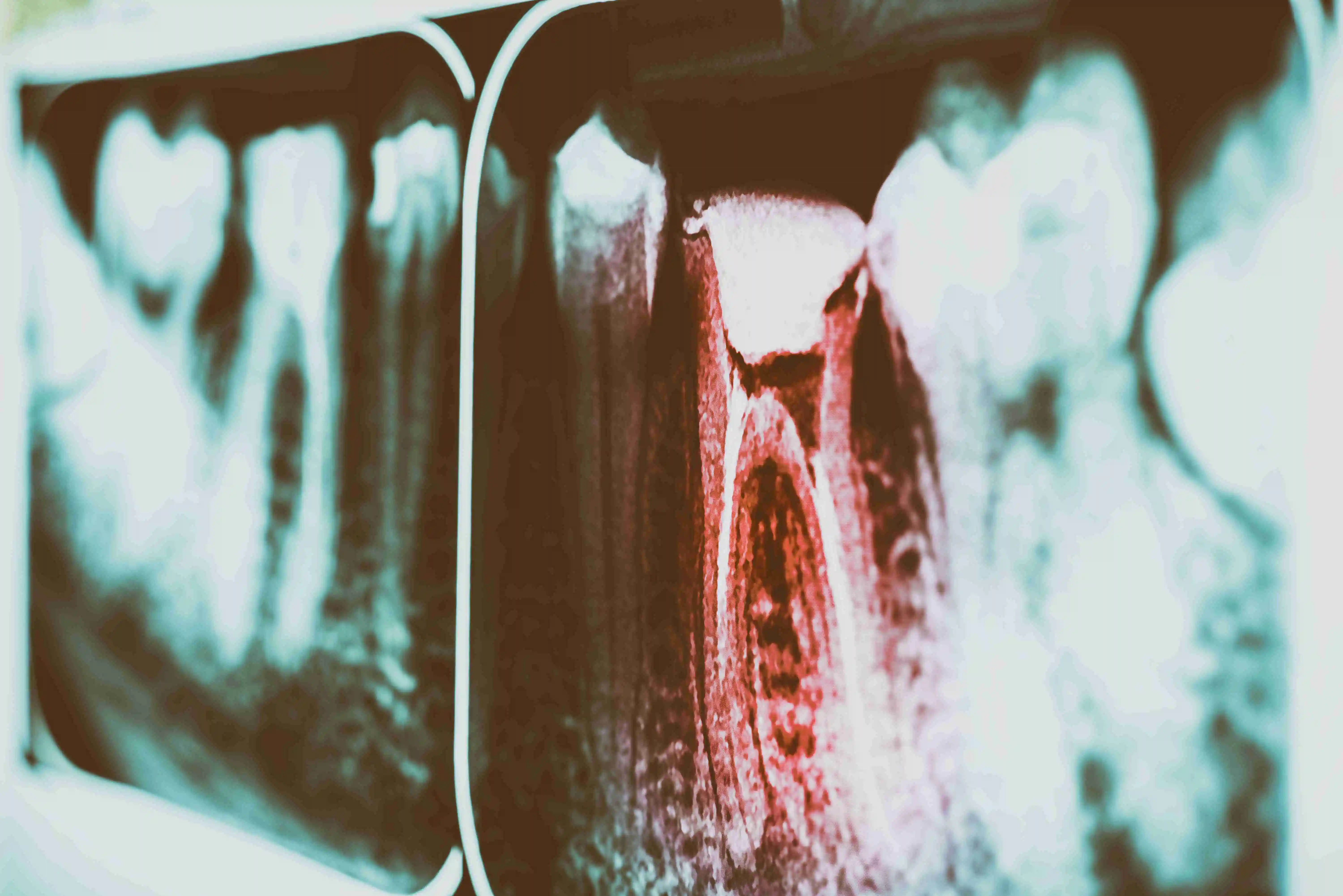 what is a root canal - Tooth Decay