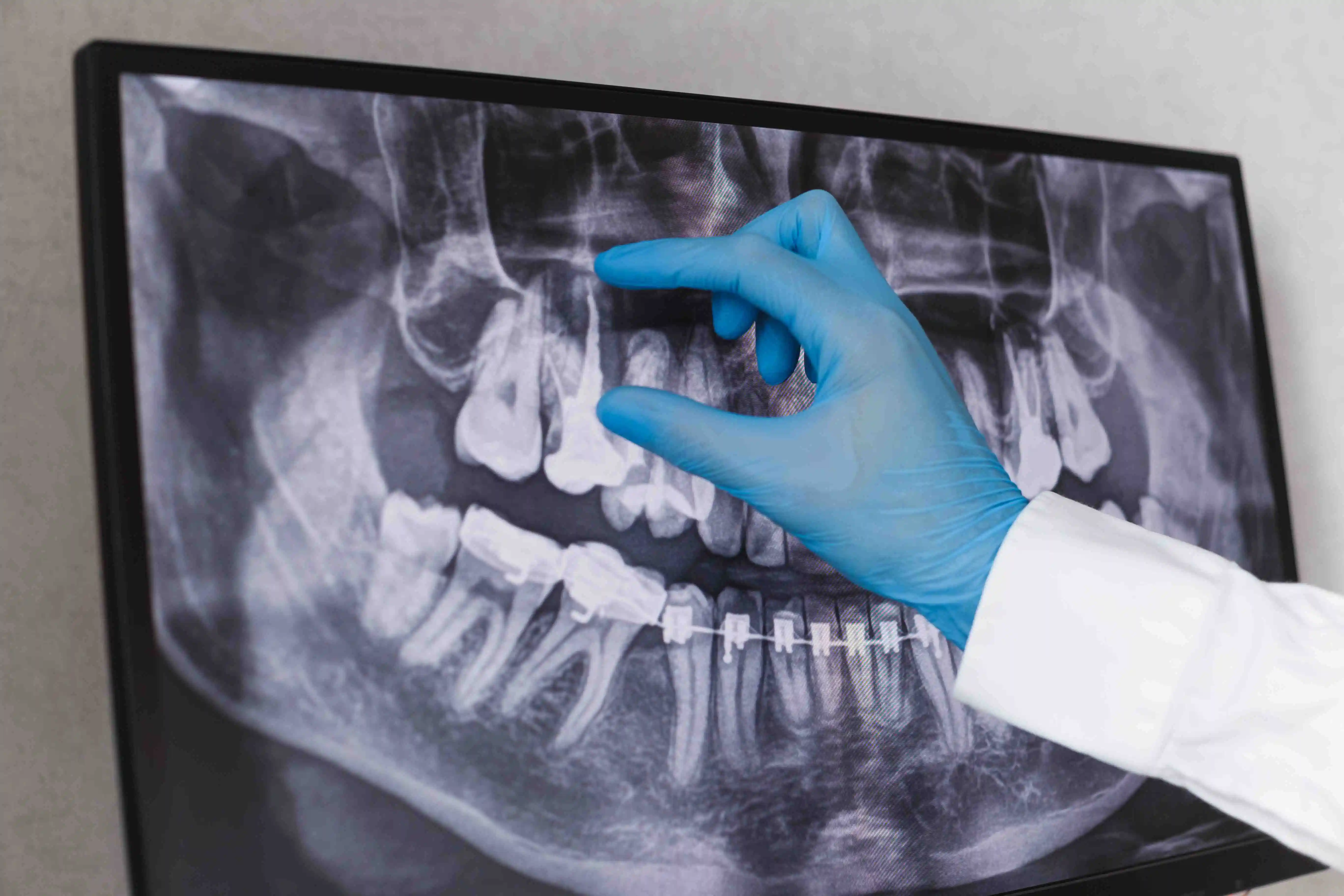 What is a root canal | Norwood Dental