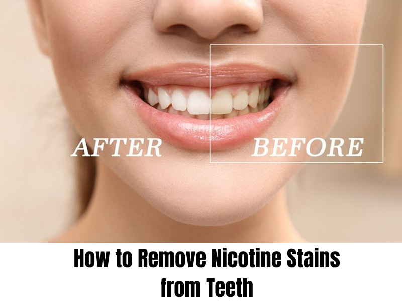 How to Remove Nicotine Stains from Teeth