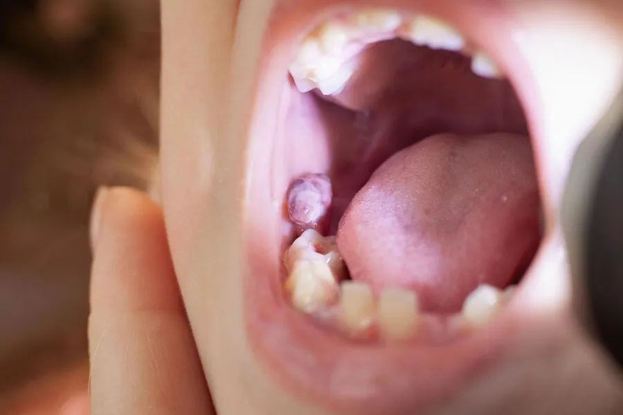 gum hematoma in child