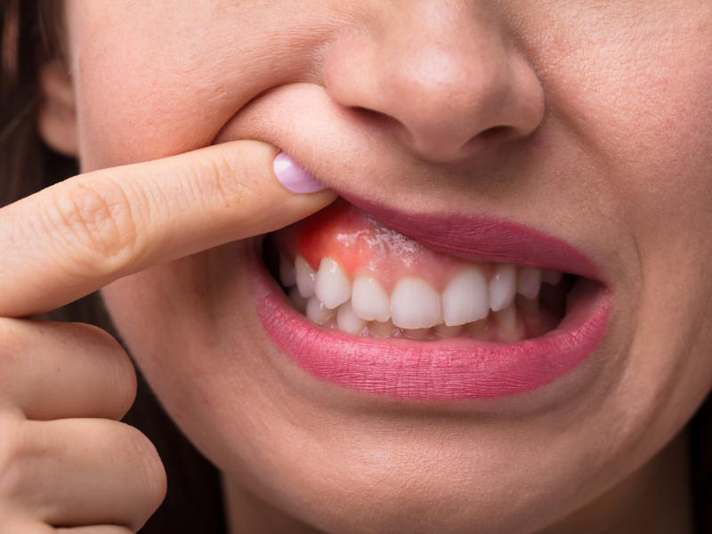 Gums Recede