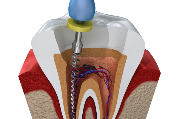 Root Canal Procedure