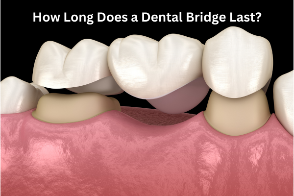 How Long Does a Dental Bridge Last