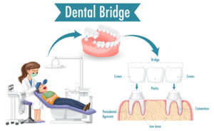 tooth implant vs dental bridge