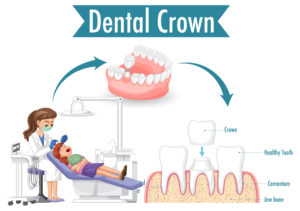 crown versus filling