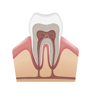 Crown Cavities