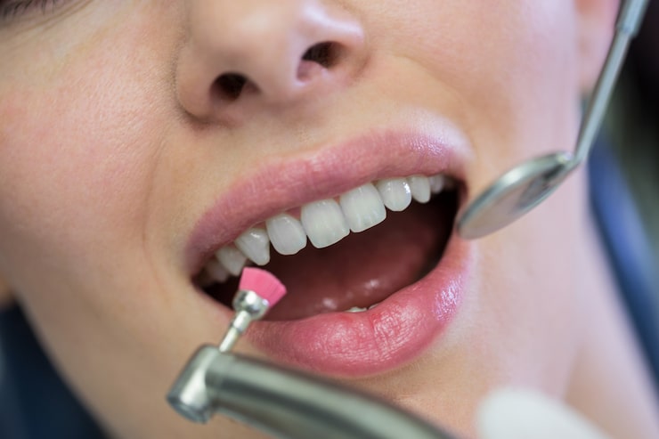 fluoride treatment for tooth decay