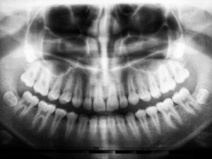 impacted wisdom teeth