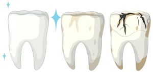 cavity symptoms